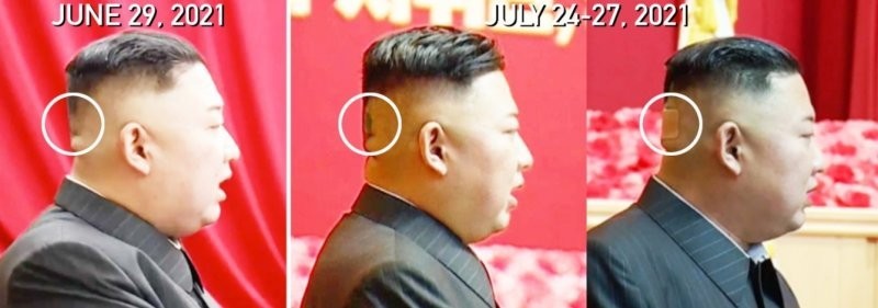 Журналисты заметили на голове Ким Чен Ына лейкопластырь и испугались за его здоровье