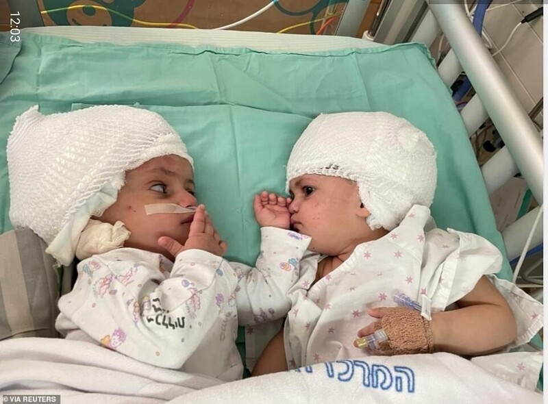 После операции: девочки впервые видят друг друга