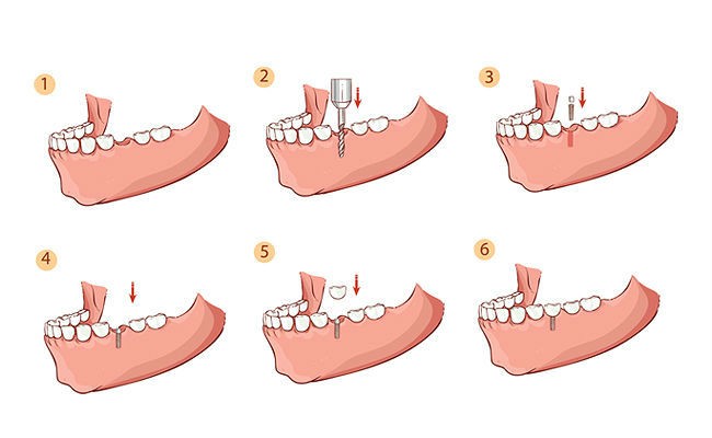 Как делают имплантацию зубов?