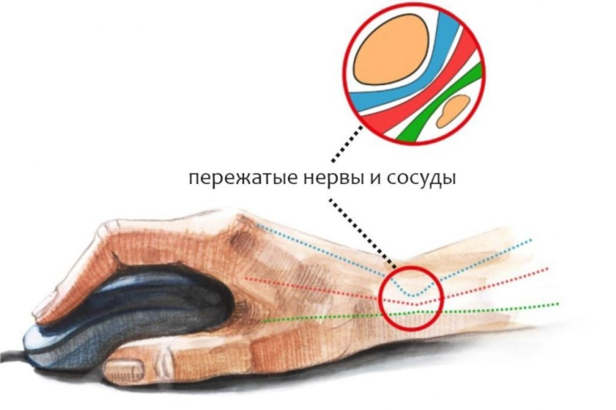 Картинки туннельный синдром