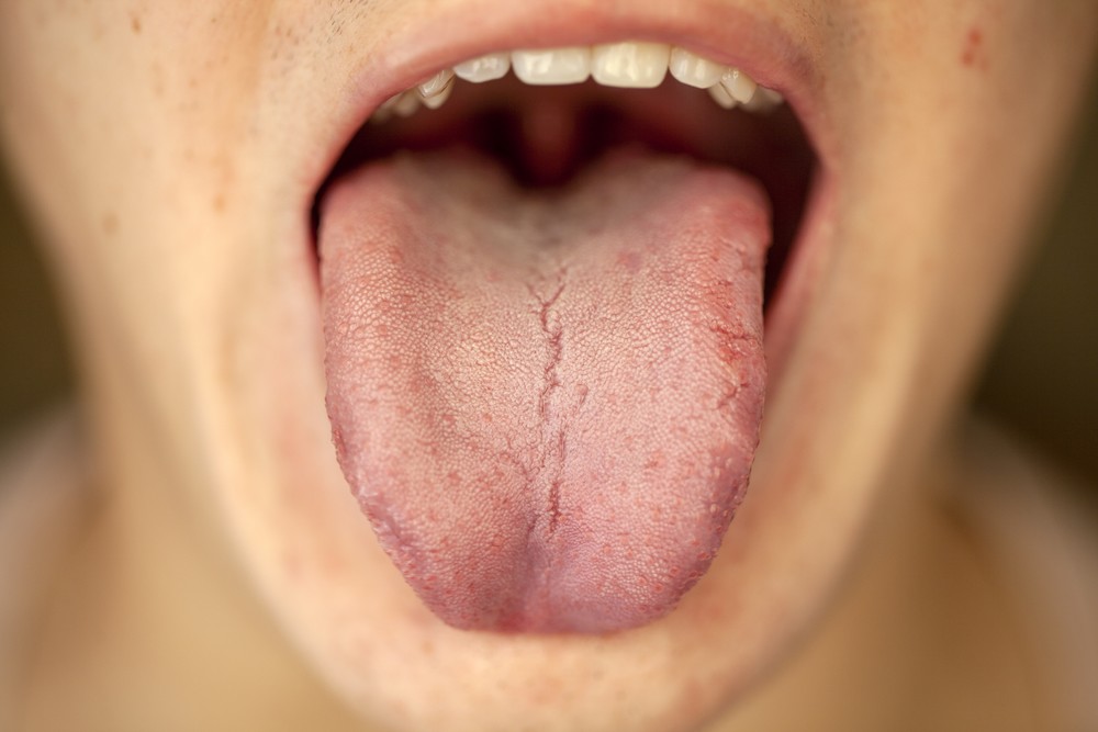 Желтый налет на языке: причины появления, болезни, меры профилактики