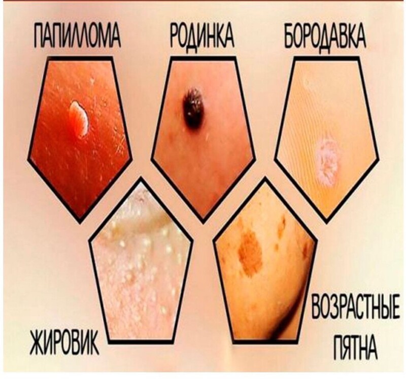 Виды образований на коже