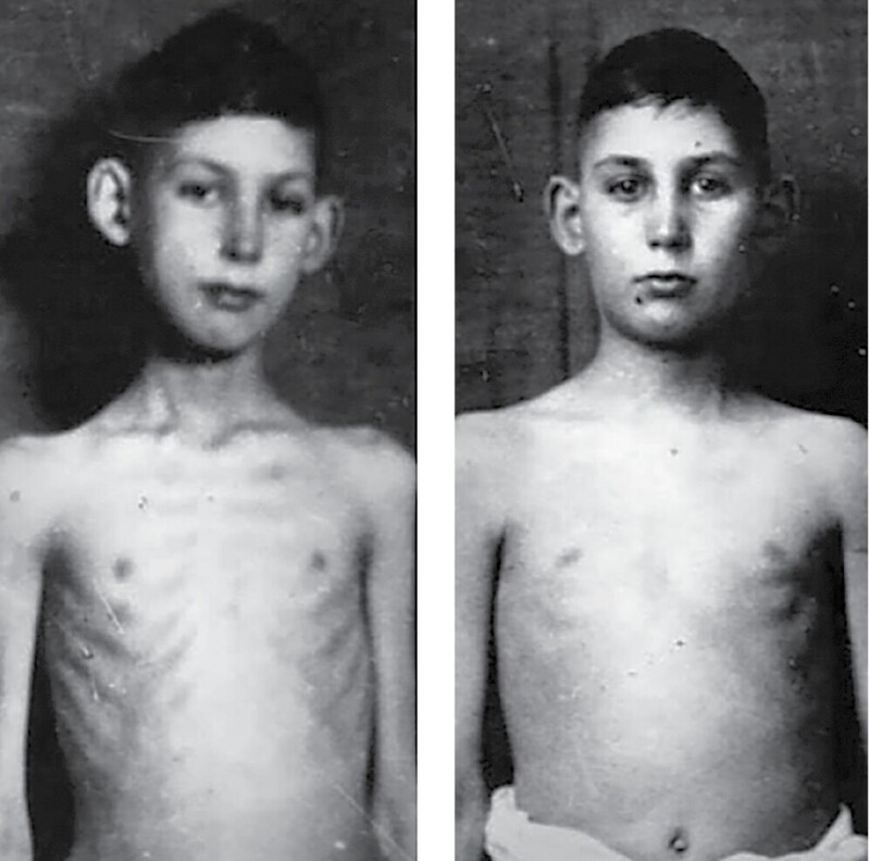 Что стало с мальчиком, который первый в мире получил укол инсулина