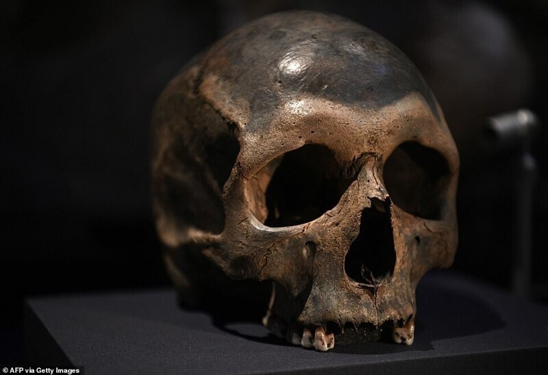 Человеческий череп с зажившей травмой лба от удара тупым предметом