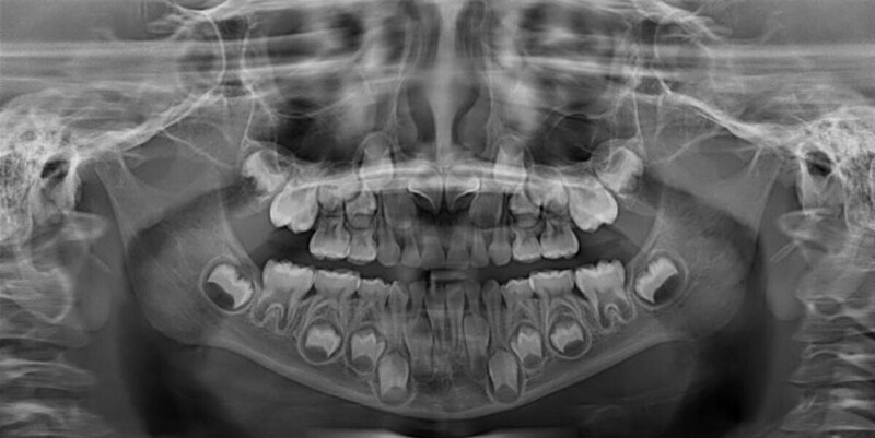 Рентгеновские снимки рта детей в возрасте от 6 до 12 лет  с их двойным комплектом зубов до сих пор поражают меня, даже после того, как я проработал стоматологом более 10 лет