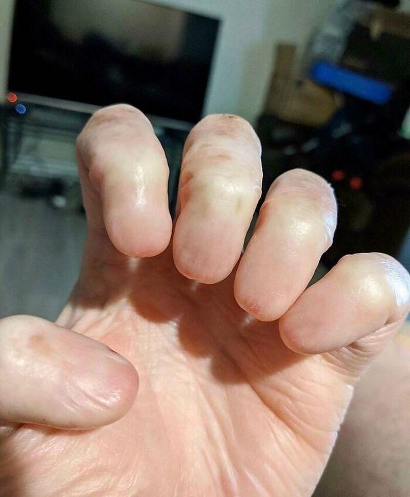 Так выглядят пальцы без ногтей