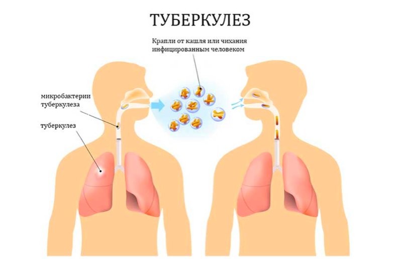 Что нужно знать об одном из самых распространенных инфекционных заболеваний