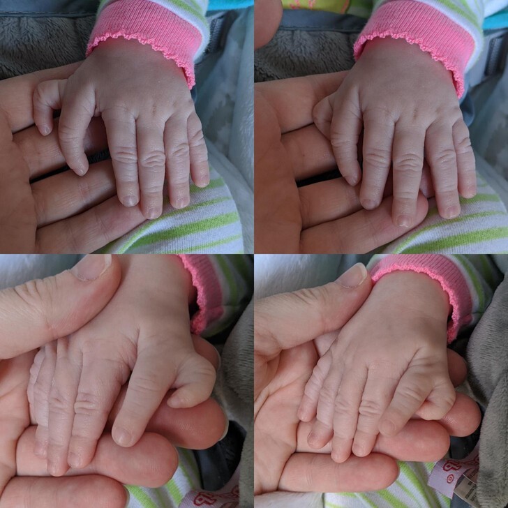 Малышка родилась с лишними пальчиками на обеих руках