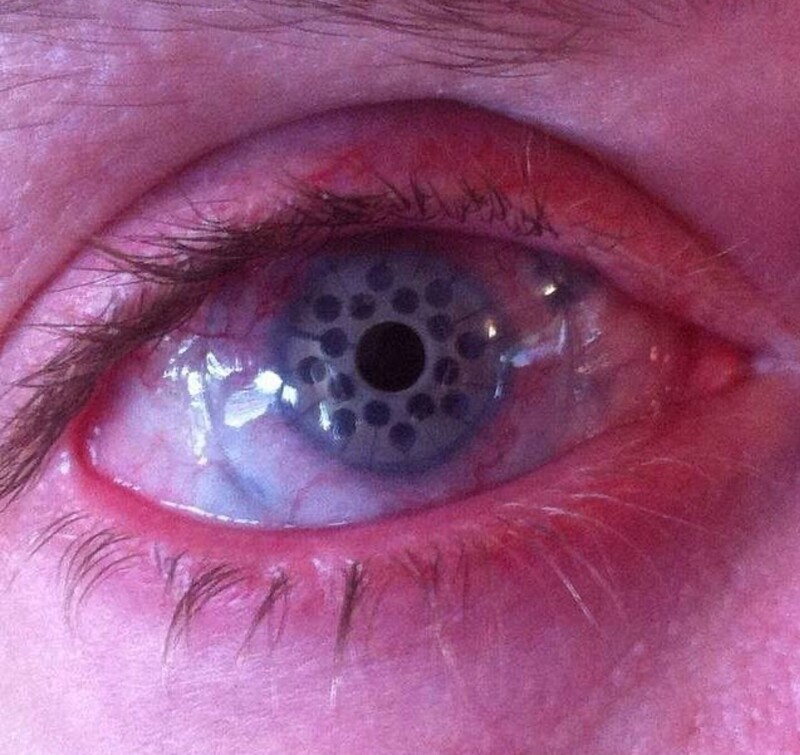 Это глаз после кератопротезирования: хирургическая процедура, при которой больная роговица заменяется искусственной