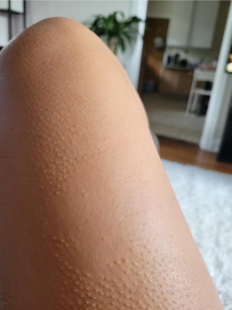 "У меня на ноге есть участок кожи, на котором никогда не выступают мурашки"