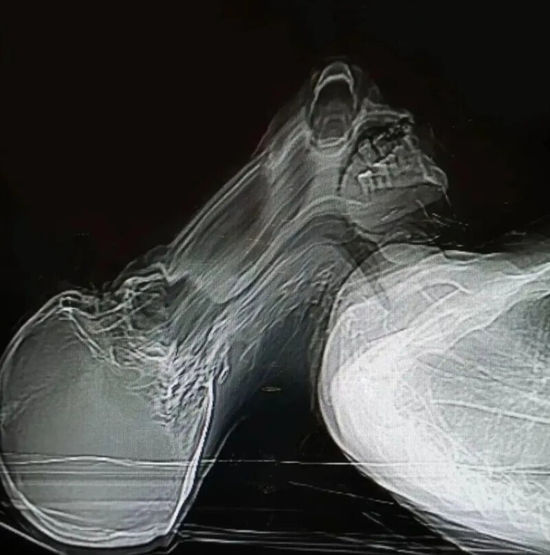 Пациент испытал клаустрофобию и паническую атаку во время компьютерной томографии