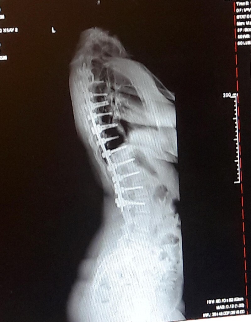 Рентгеновский снимок железной конструкции в позвоночнике