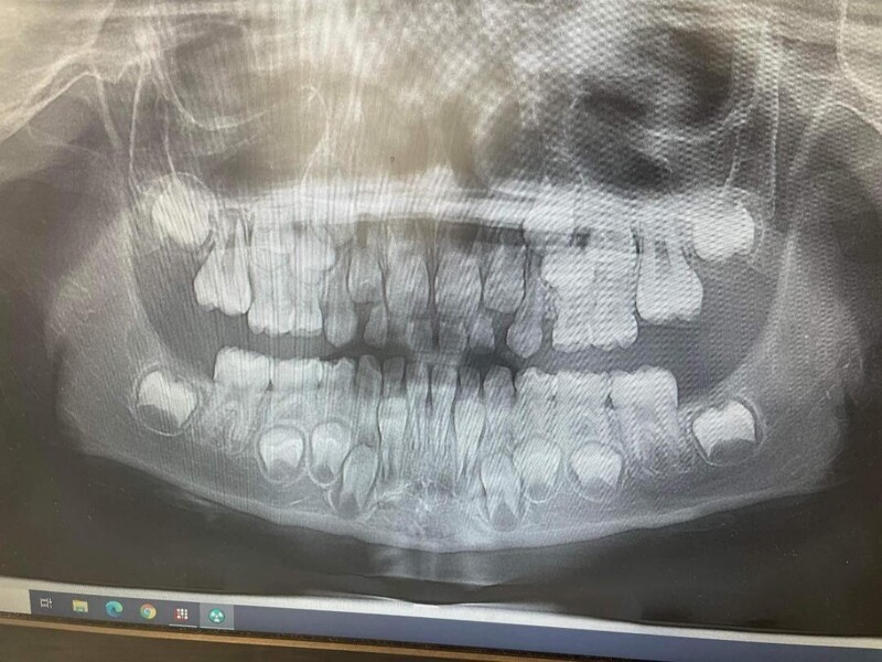 Снимок зубов 7-летнего ребёнка