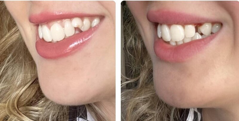 Молочные зубы могут не выпадать очень долго, у этой девушки последний выпал в 24 года