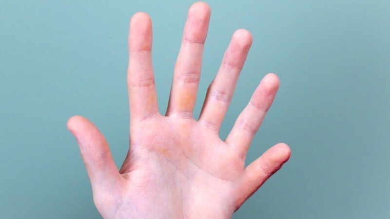 Избыточное количество пальцев (полидактилия) - доминантный ген