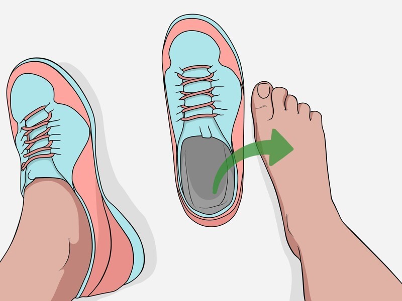 Как лечить вросший ноготь на ноге