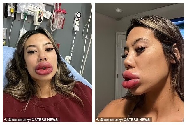 Девушка решила сделать губы по акции и попала в больницу
