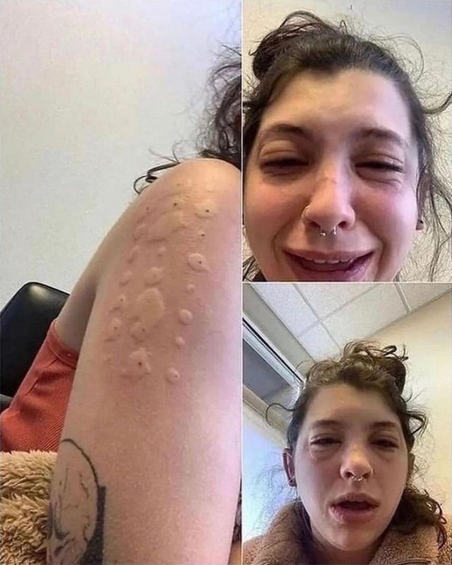 Девушка хотела выяснить, на что у нее аллергия, но тесты пошли не по плану: реакция на всё