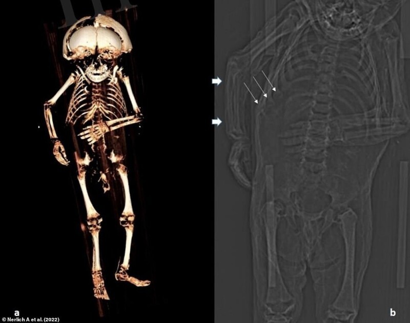 A: Трехмерная реконструкция скелета. B: Часть топограммы, показывающая утолщение реберных хрящей ("реберные четки"), что свидетельствует о рахите