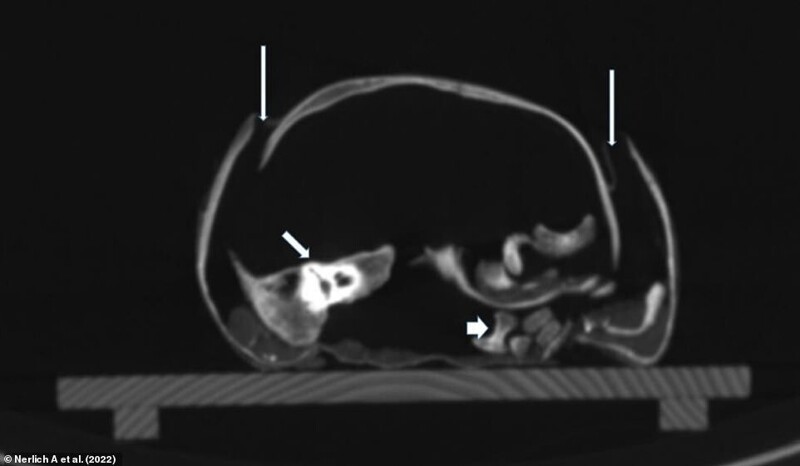 КТ основания черепа, показывающая обширный вывих костей