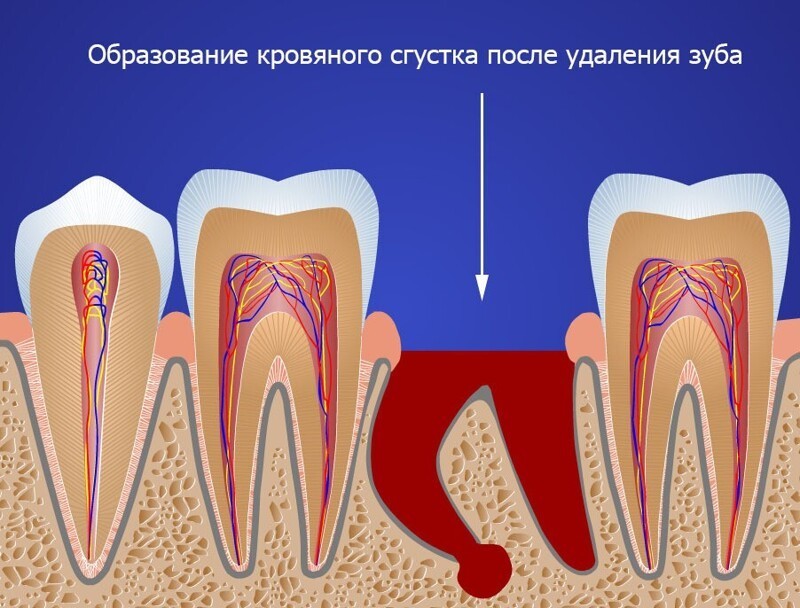 Как пережить удаление зуба