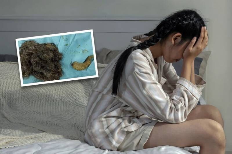 14-летняя девочка из Китая выдрала и съела 3 кг волос