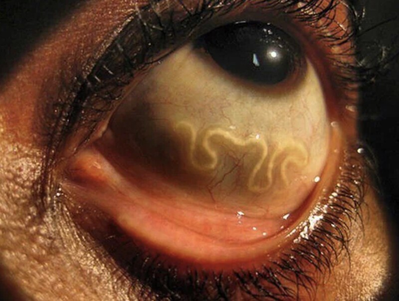 Loa loa - глазной червь. Перемещаясь по тканям человеческого организма, этот червь может добраться до глаз