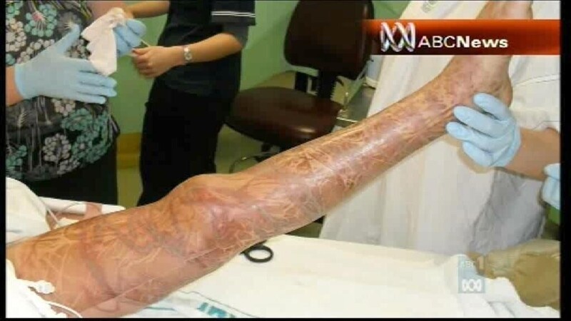 Австралийская девочка после укуса кубомедузы