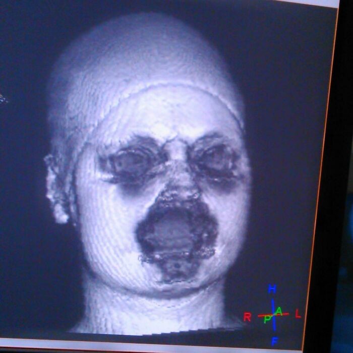 19. Вот как выглядит 3D МРТ-реконструкция лица с макияжем. Металлические частицы в туши для ресниц и т. д. мешают сигналу аппарата МРТ