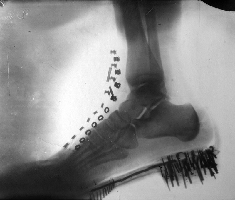 Нога Николы Теслы в обуви на рентгеновском снимке, сделанном им самим на устройстве собственной конструкции, 1896 год