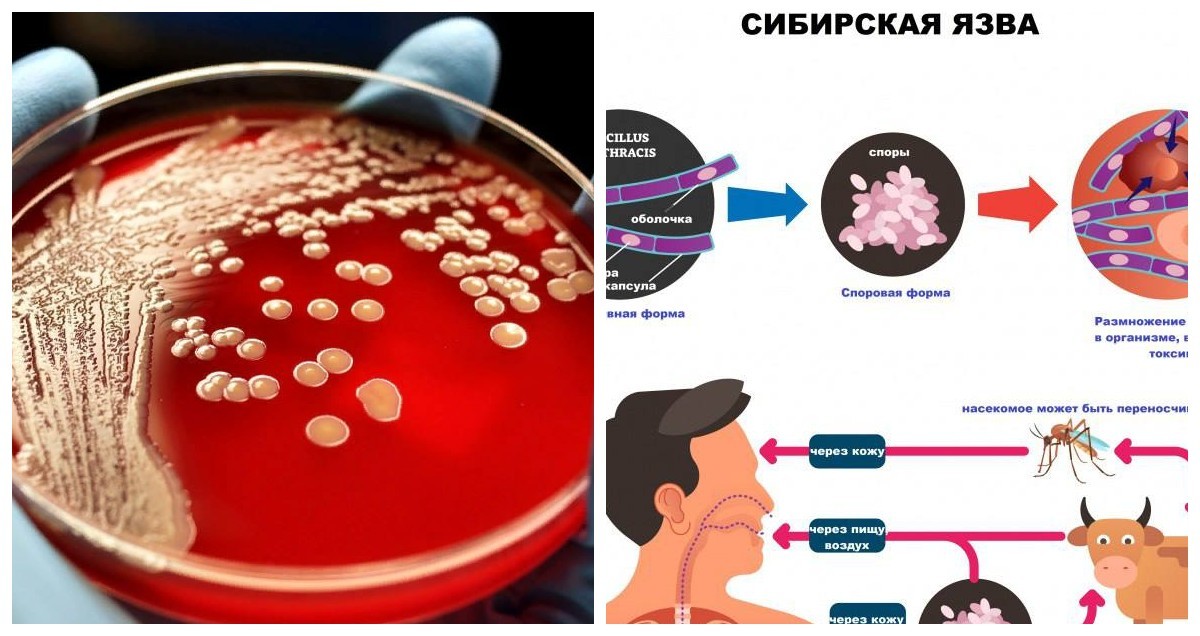 Лечение сибирской язвы