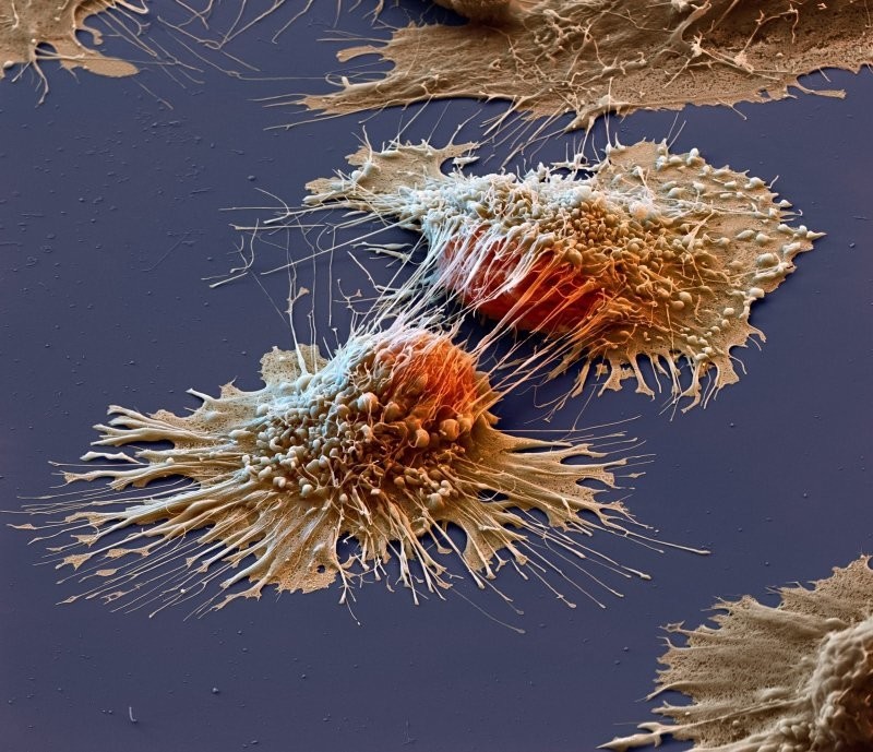 13. Раковые клетки под микроскопом