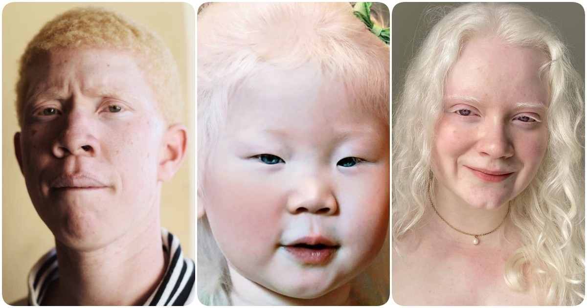 Альбинизмом страдают. Глазокожный альбинизм. Глазно-кожный альбинизм. Глазокожный альбинизм 1 а.