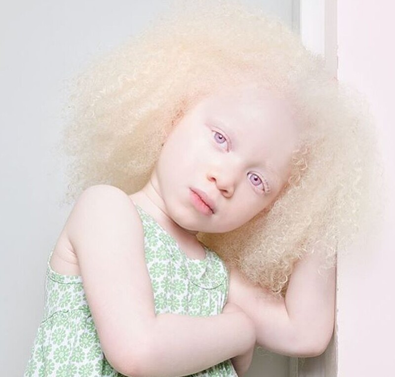 1. Альбинизм - это редкое генетическое заболевание