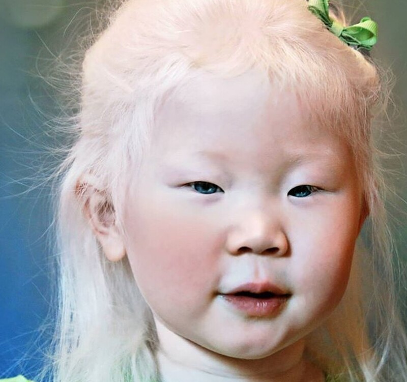 2. У людей с альбинизмом полное или частичное отсутствие пигмента (меланина) в волосах, коже, глазах
