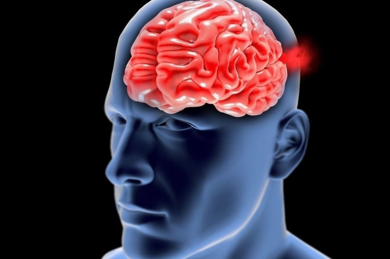 5. Аневризмы головного мозга обычно не имеют симптомов, а при разрыве могут привести к смерти