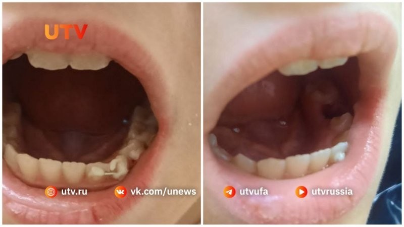 В Уфе стоматолог удалил ребенку коренной зуб вместо молочного, а потом прикрепил его обратно