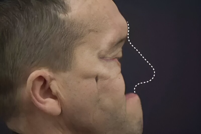 Пластические хирурги из Беларуси вырастили нос на руке