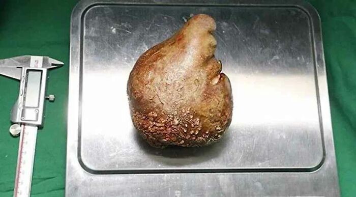 16. Самый большой в мире камень в почке, удаленный у пациента из Шри-Ланки, весил 757,5 г и побил два мировых рекорда