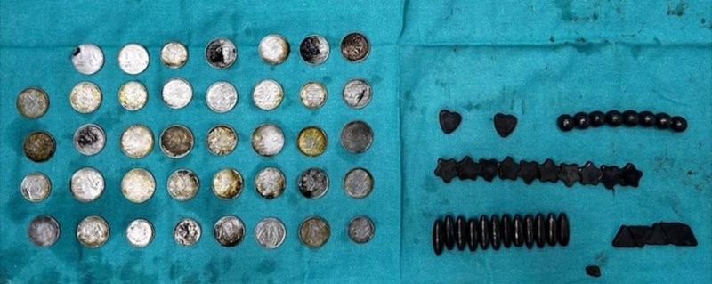 Культурист из Индии проглотил 39 монет и 37 магнитов