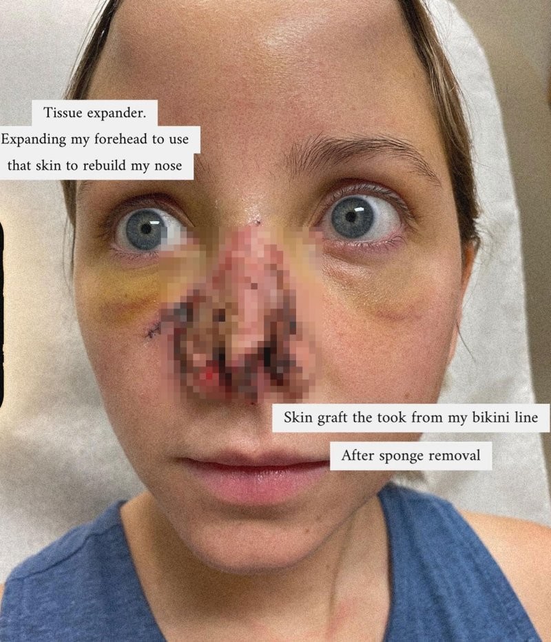 Женщине потребовалось 16 операций, чтобы восстановить нос после укуса собаки