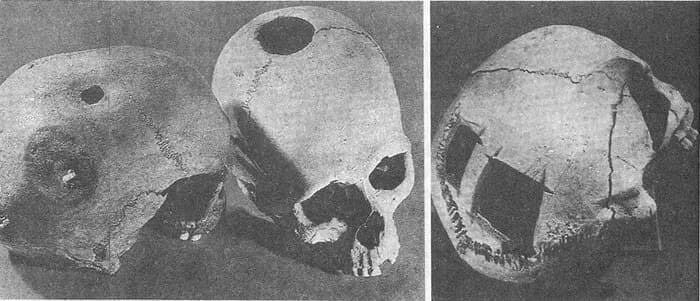 Череп с дыркой: как лечили психические болезни в каменном веке