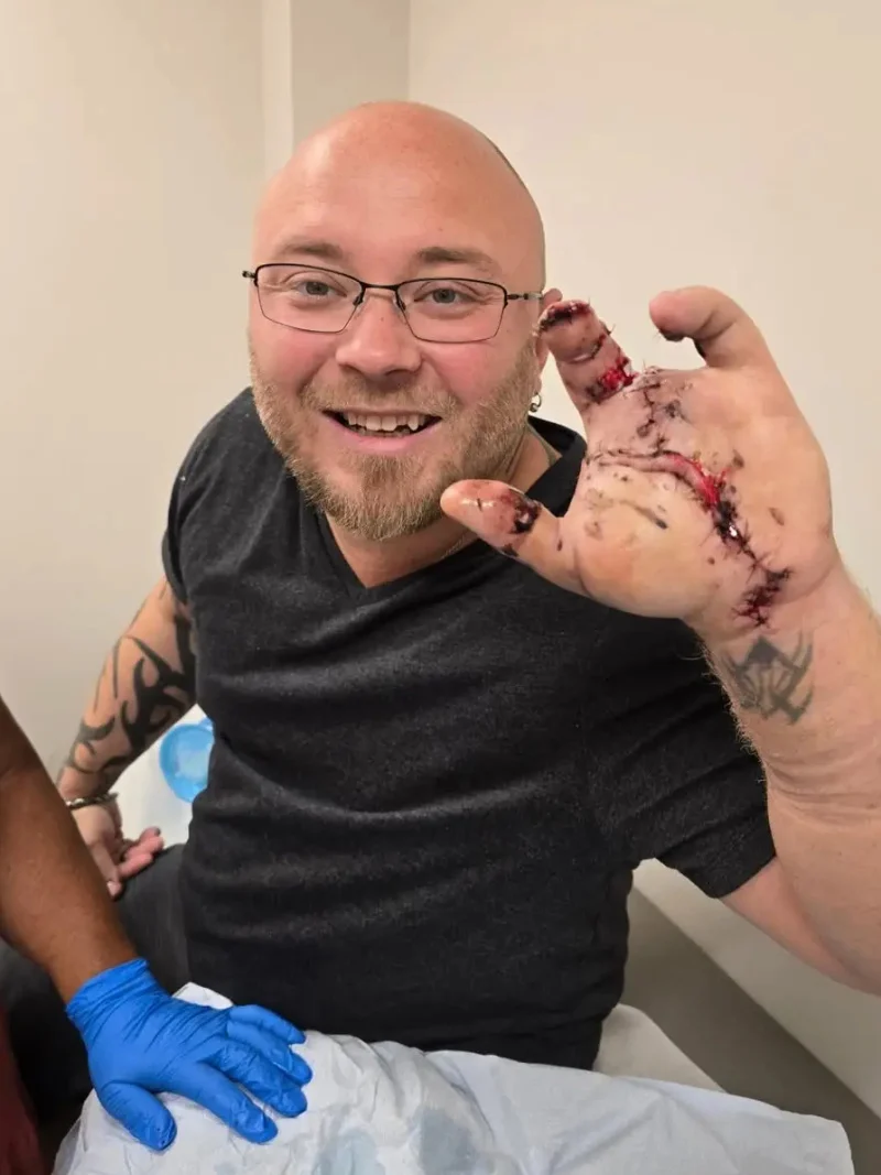 Во Флориде мужчина потерял пальцы, держа в руках петарду