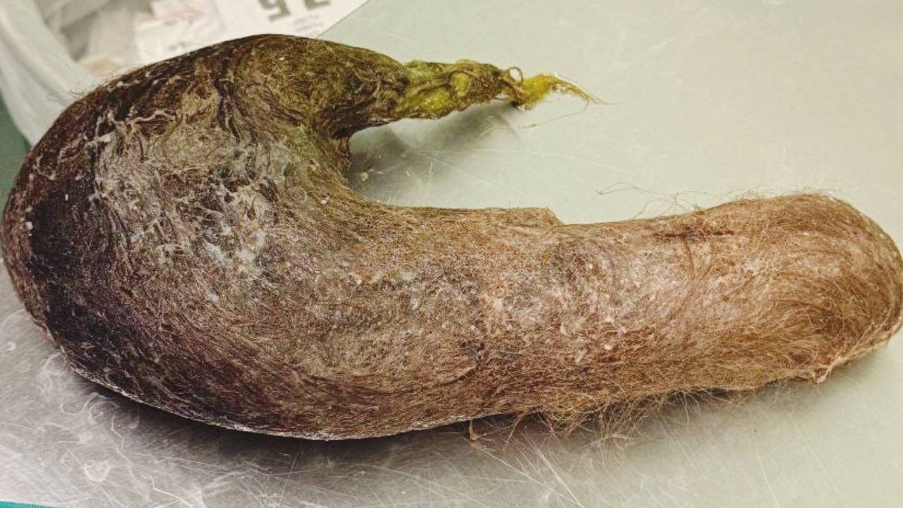 Огромный волосяной комок достали из желудка девушки