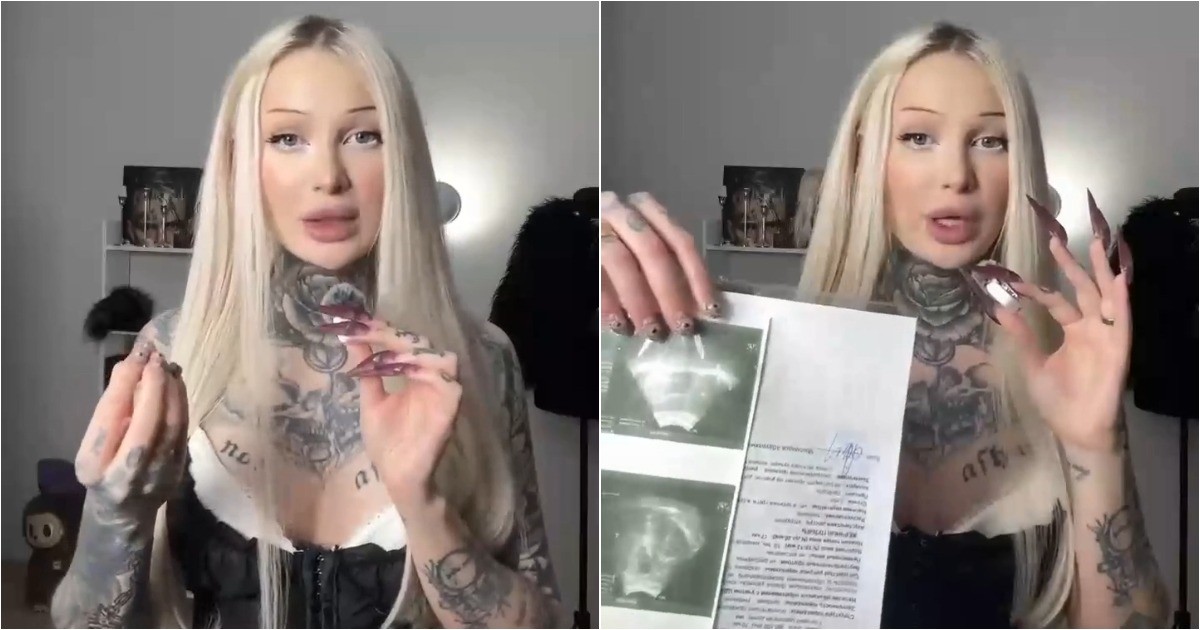 Лечение акне привело к костному наросту на ноге у девушки