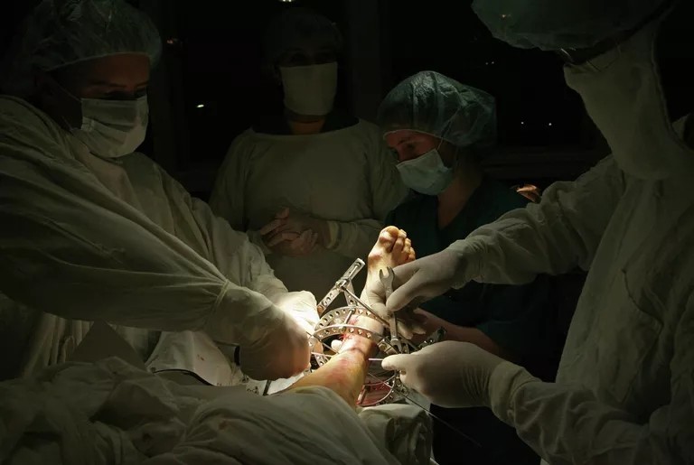 Хирурги проводят операцию по установке аппарата доктора Илизарова на травмированную стопу
