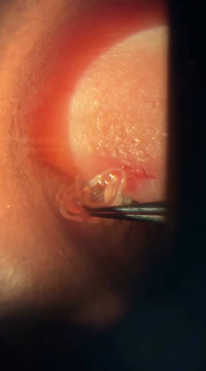 Опасный укус: комар занёс паразита в глаз жительницы Дагестана