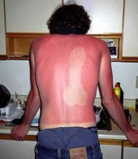 14 людей, забавно обгоревших на солнце