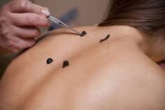 Пиявками! Пиявками бабушки в деревнях лечили все от зубной боли до радикулита. И помогает. Сейчас гирудотерапия называется. Эффективно и при ушибах, травмах (отек снимает мгновенно) и при давлении.
Лечили банками с надрезом,  баней и медом!