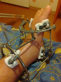 У меня в январе сняли с ноги его изобретение